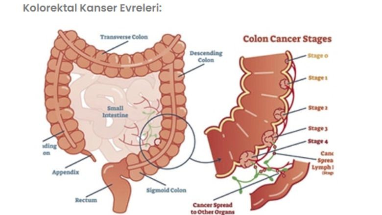 Kolorektal Kanser Nedir ve Yaygın mıdır ? 