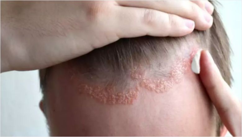 Seboreik Dermatit Hastalığı Nedir?