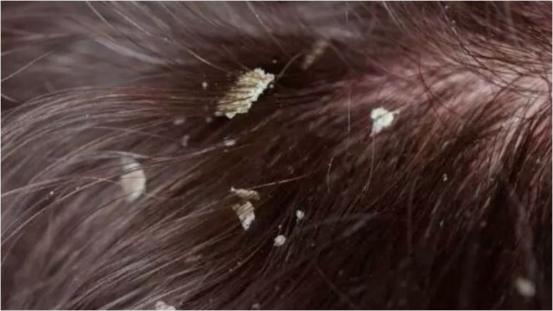 Seboreik Dermatit Hastalığı Nedir?