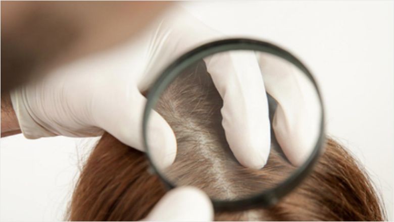 Seboreik Dermatit Hastalığı Nedir?