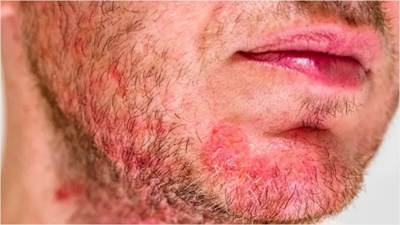 Seboreik Dermatit Hastalığı Nedir?