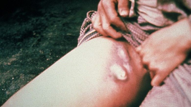 İlk Vaka ABD'li Yetkililer Tarafından Doğrulandı