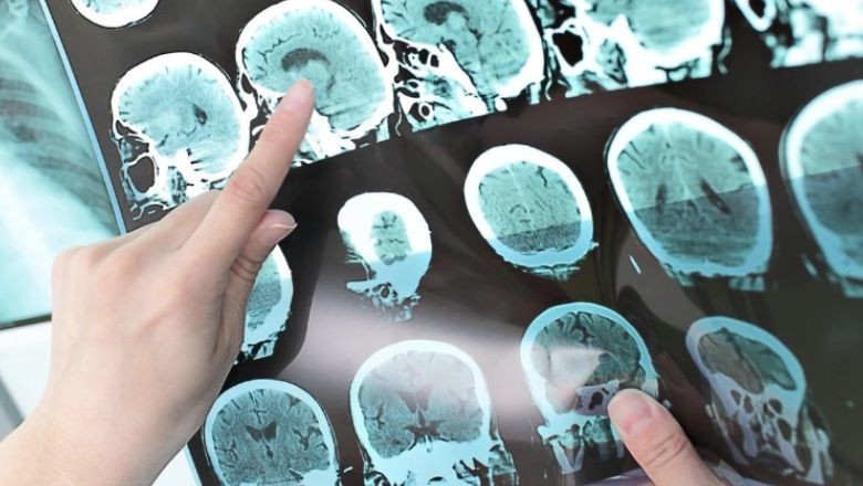Yapay Zeka Alzheimer’ı Erken Tespit Ediyor