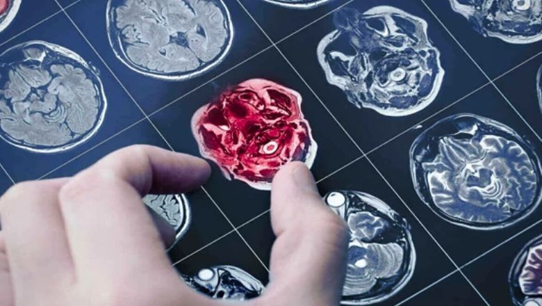 Yapay Zeka Alzheimer’ı Erken Tespit Ediyor