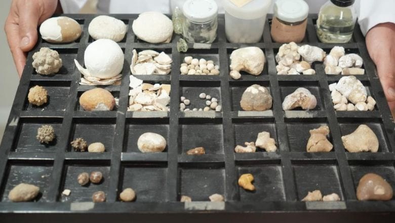 22 Yıldır Ameliyatla Aldığı Böbrek Taşlarını Biriktiriyor