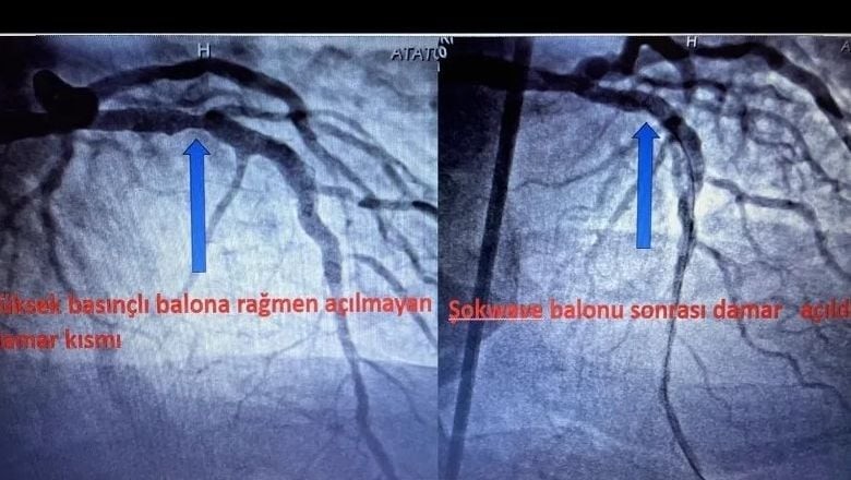 Balıkesir’de Kalp Sağlığında Bir İlk Gerçekleştirildi
