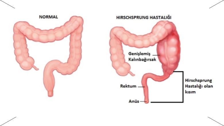 Balıkesir'de Hirschsprung'un Çaresi Bulundu