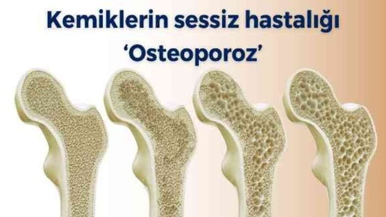 Osteoporoza Karşı Alınacak Önlemler