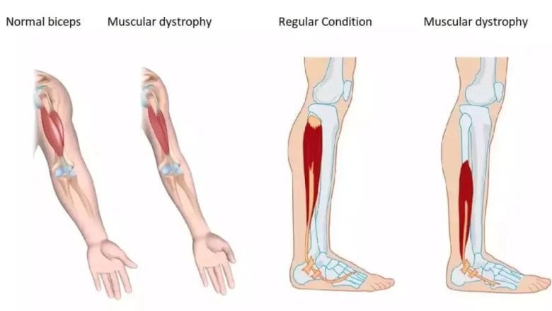 DMD Kas Hastalığı Nedir?