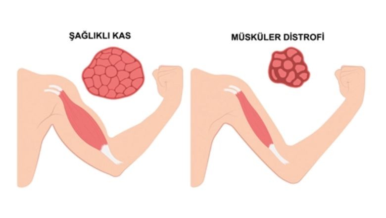 DMD Kas Hastalığı Nedir?