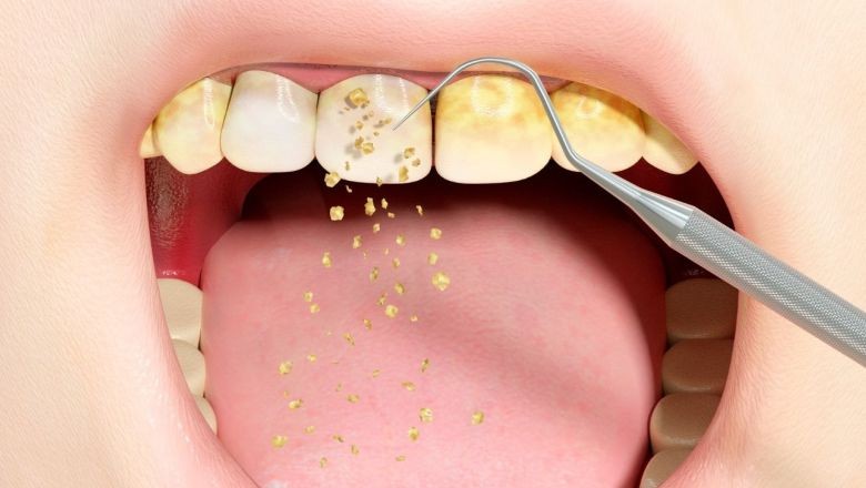 Diş Tartarı (Diş Taşı) Nedir? Zararları Nelerdir ve Nasıl Önlenir?
