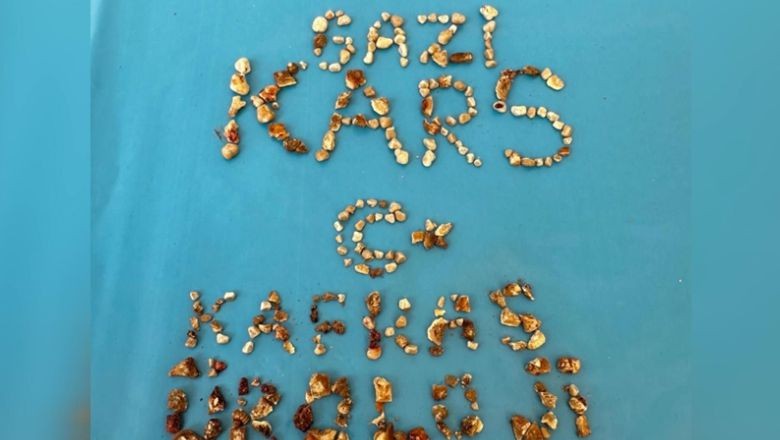 Kars’ta Bir Hastanın Böbreklerinden 300’ü Aşkın Taş Çıktı