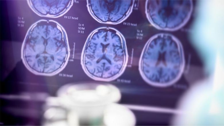 Alzheimer'ın İlk Belirtisi Bağırsaklarda!