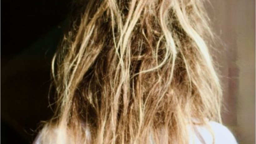 Nemsiz Saç Belirtisi: Ne Yapılmalı?