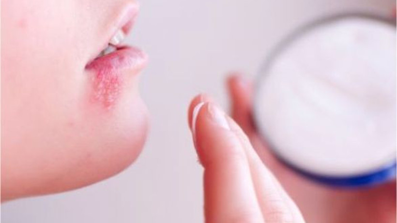 Uçuk Bakımı Nasıl Yapılır? En Hızlı Nasıl Geçer?