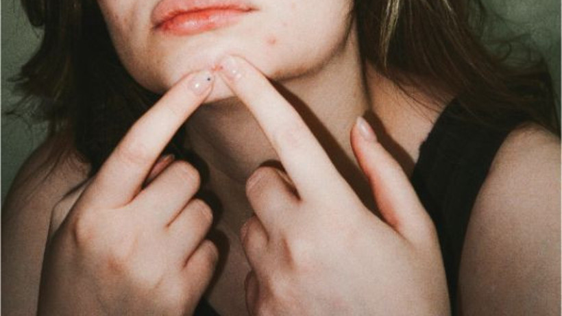 Akne ve Sivilce İzleriyle Mücadele