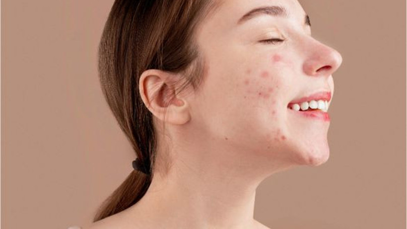 Sivilce İzlerine 5 Adımda Veda Edin!