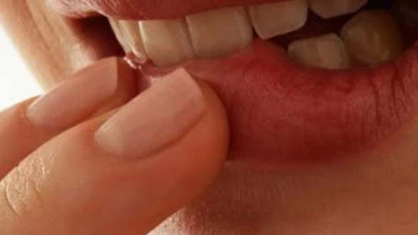 Ağız kanseri belirtileri ve tedavisi