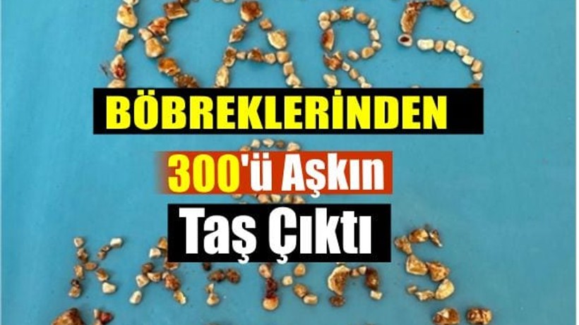 Hastanın Böbreklerinden 300’ü Aşkın Taş Çıktı