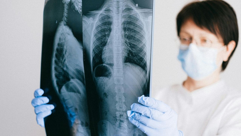 Akciğer Kanseri: Sinsi Ama Önlenebilir