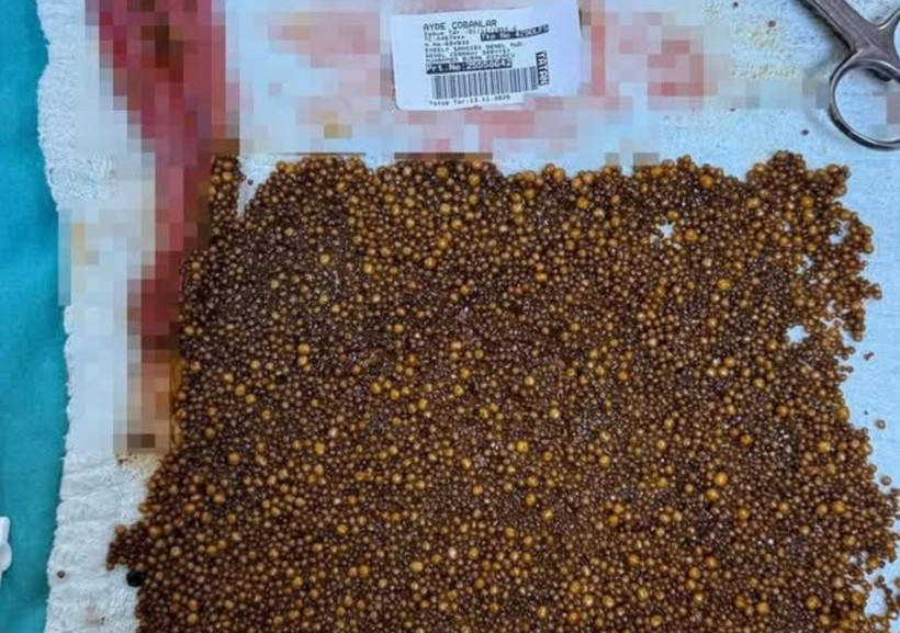 Soma’da 70 Yaşındaki Kadının Safra Kesesinden 20 Bin Taş Çıkarıldı