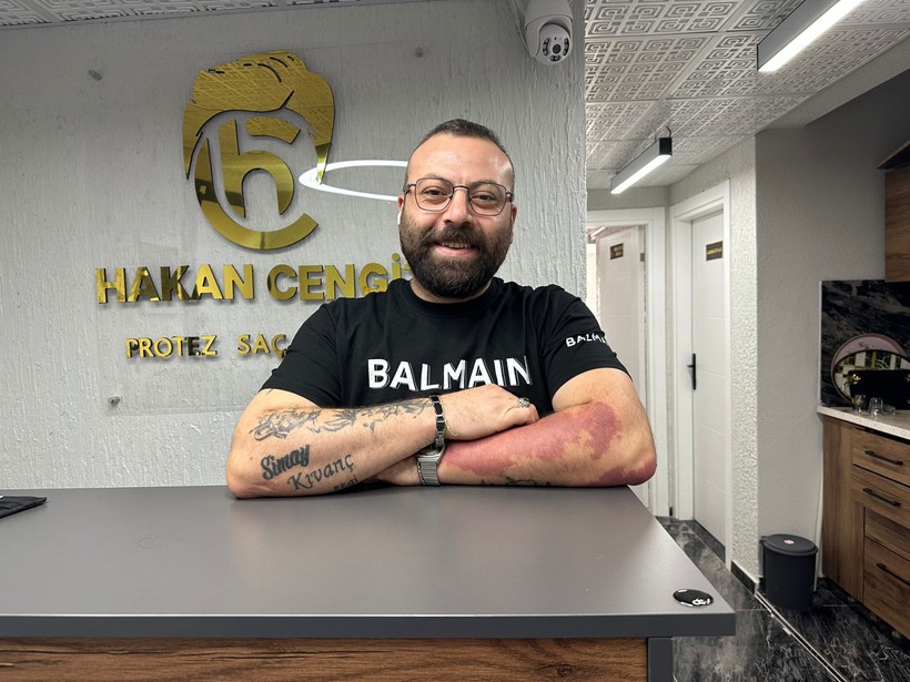 Balıkesir’de Erkeklere Özel Protez Saçla Özgüven Geri Geliyor